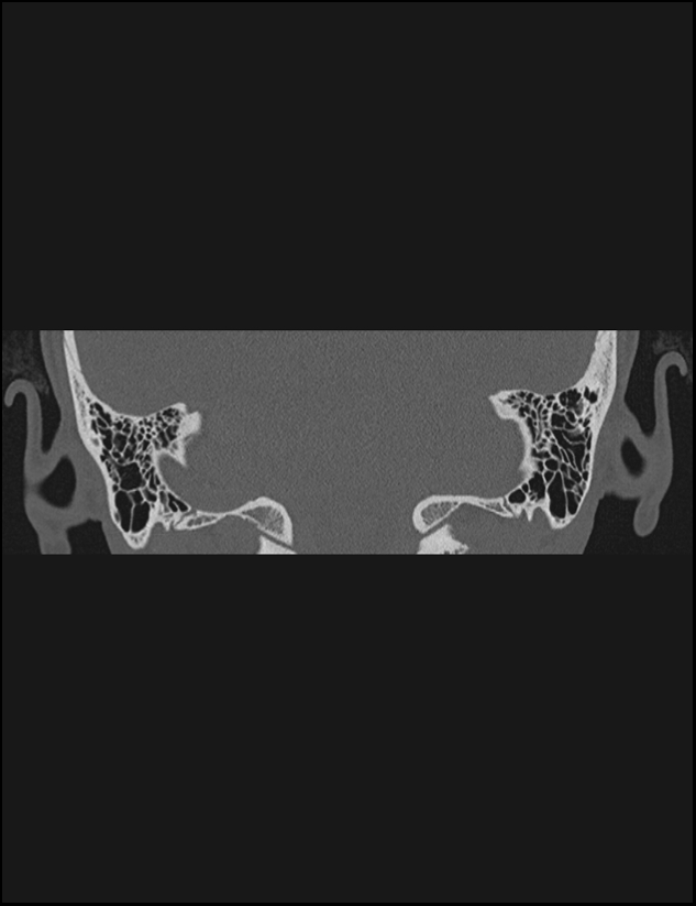 Aberrant right internal carotid artery (Radiopaedia 65191-74198 Coronal non-contrast 65).jpg