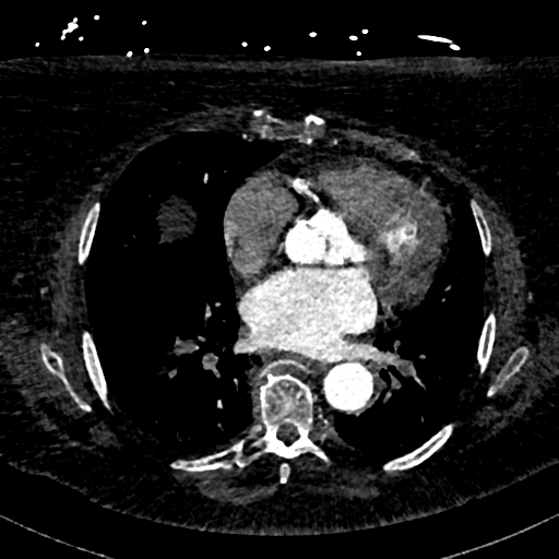 Aberrant right subclavian artery with Kommerell diverticulum (Radiopaedia 47982-52769 Axial C+ arterial phase 55).png