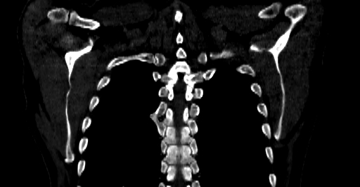 Accesory rib joint (Radiopaedia 71987-82452 Coronal bone window 56).jpg
