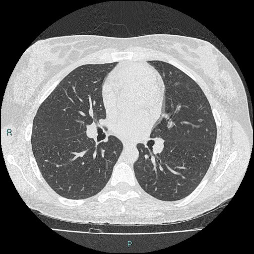 File:Accidental foreign body aspiration (seamstress needle) (Radiopaedia 77740-89983 Axial lung window 33).jpg