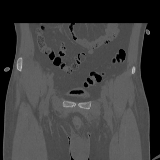 Acetabular and ilial fractures (Radiopaedia 59084-66378 Coronal bone window 10).jpg
