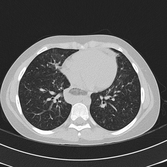 Achalasia (Radiopaedia 14946-14878 Axial lung window 49).jpg