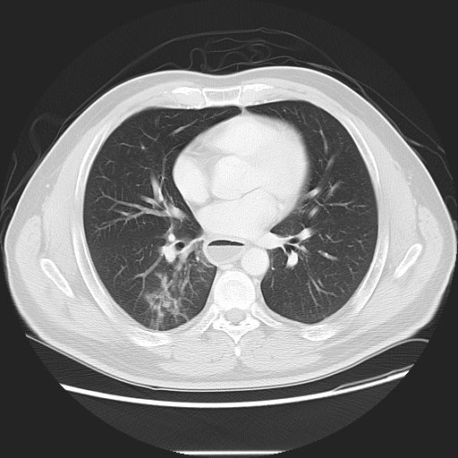 Achalasia (Radiopaedia 8831-9629 Axial lung window 35).jpg