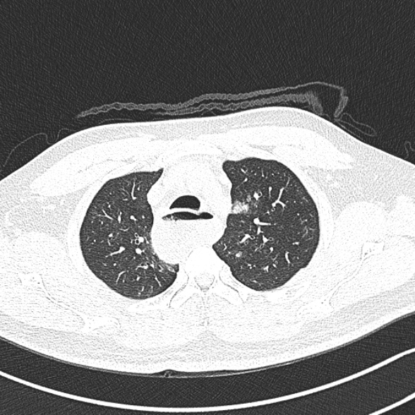 Achalasia with aspiration (Radiopaedia 55413-61845 Axial lung window 15).jpg