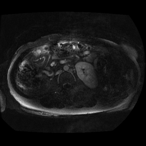 Acinar cell carcinoma of the pancreas (Radiopaedia 75442-86668 Axial T1 C+ fat sat 8).jpg