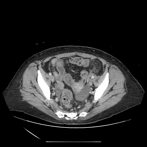 Acinar cell carcinoma of the pancreas (Radiopaedia 75442-86669 Axial C+ portal venous phase 123).jpg
