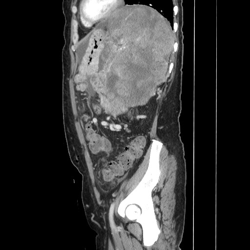 Acinar cell carcinoma of the pancreas (Radiopaedia 75442-86669 Sagittal C+ portal venous phase 138).jpg