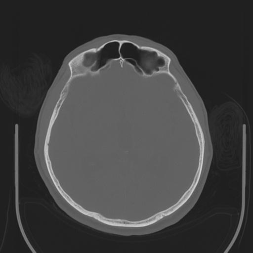 File:Acoustic schwannoma (Radiopaedia 29488-29982 AXIAL BONE THICK non-contrast 24).jpg