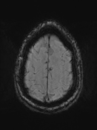 File:Acoustic schwannoma (Radiopaedia 55729-62281 Axial SWI 45).png