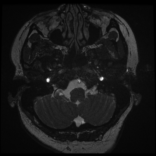 Acoustic schwannoma (Radiopaedia 57574-64536 Axial T2 6).png