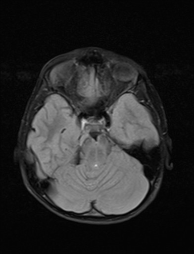 File:Acquired cerebellar tonsillar ectopia (Radiopaedia 39950-42423 Axial FLAIR 7).jpg