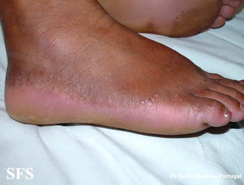 Acrokeratoelastoidosis (Dermatology Atlas 3).jpg