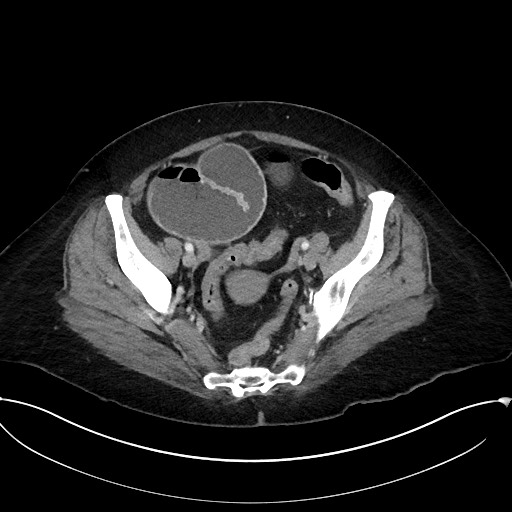 Active Crohn disease (Radiopaedia 59394-66750 Axial C+ portal venous phase 59).jpg