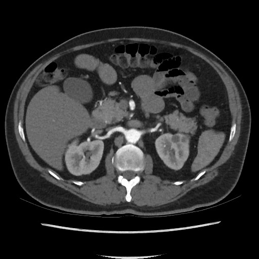 File:Active colonic bleed on CT (Radiopaedia 49765-55025 Axial C+ arterial phase 30).jpg