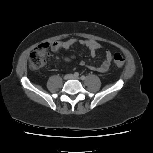 File:Active colonic bleed on CT (Radiopaedia 49765-55025 Axial C+ delayed 55).jpg