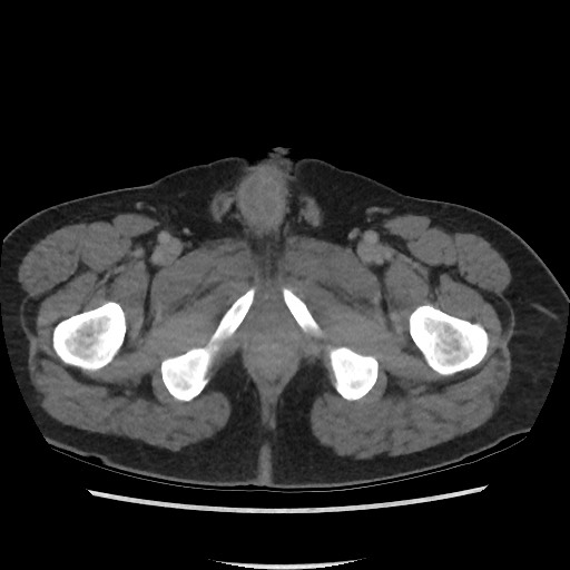 File:Active colonic bleed on CT (Radiopaedia 49765-55025 Axial C+ delayed 88).jpg
