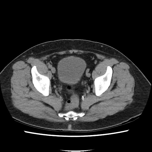 File:Active colonic bleed on CT (Radiopaedia 49765-55025 Axial non-contrast 73).jpg