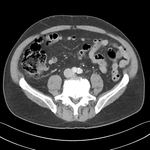 File:Active diverticular hemorrhage (Radiopaedia 39415-41725 Axial C+ portal venous phase 42).png