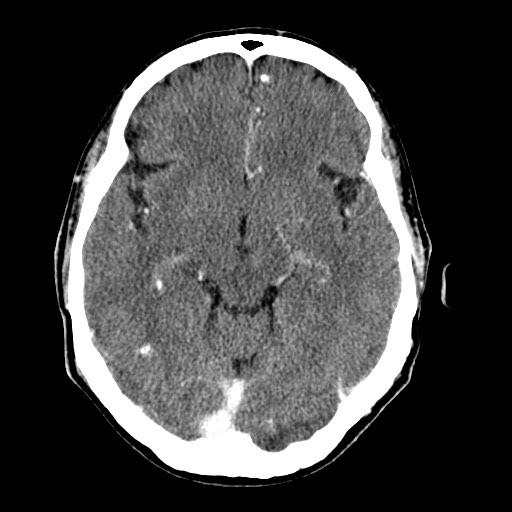File:Active neurocysticercosis before and after therapy (Radiopaedia 71710-82099 Axial C+ delayed 62).jpg