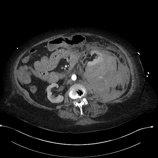 File:Active renal extravasation with large subcapsular and retroperitoneal hemorrhage (Radiopaedia 60975-68796 Axial C+ arterial phase 89).jpg