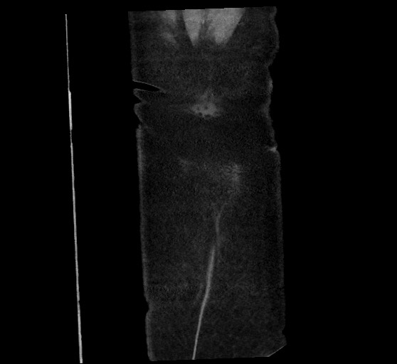 Active renal extravasation with large subcapsular and retroperitoneal hemorrhage (Radiopaedia 60975-68796 Coronal C+ arterial phase 146).jpg
