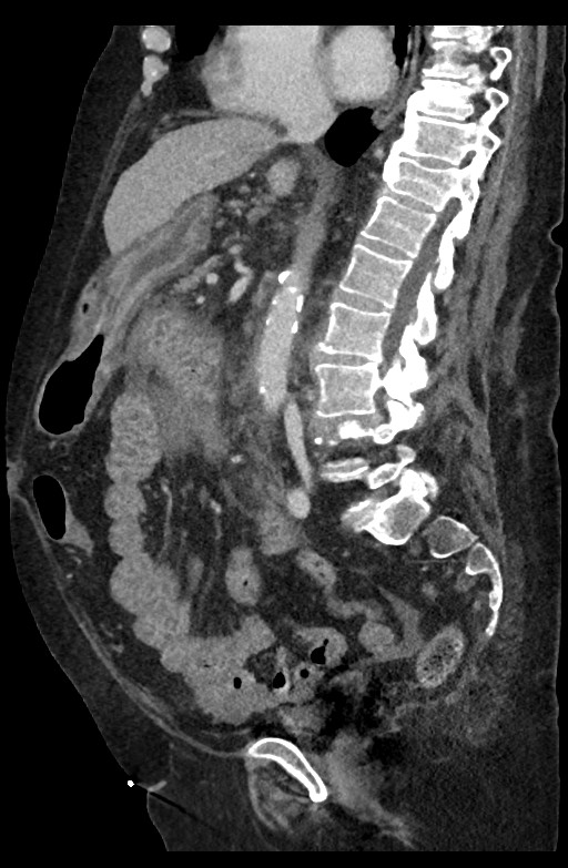Active renal extravasation with large subcapsular and retroperitoneal hemorrhage (Radiopaedia 60975-68796 Sagittal C+ portal venous phase 125).jpg