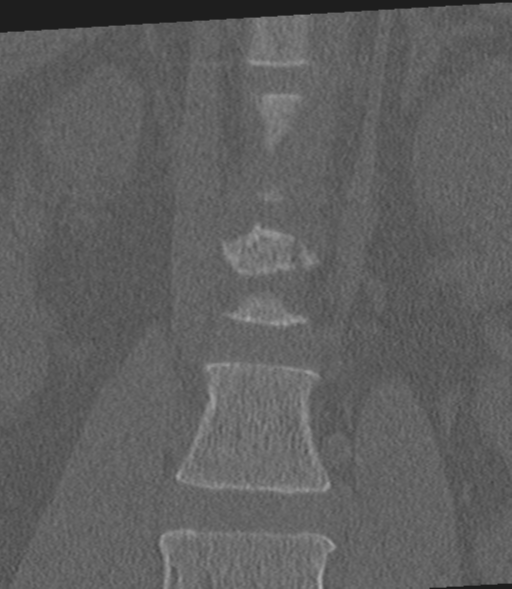 Acute L1 burst compression fracture (Radiopaedia 34430-35755 Coronal bone window 13).png
