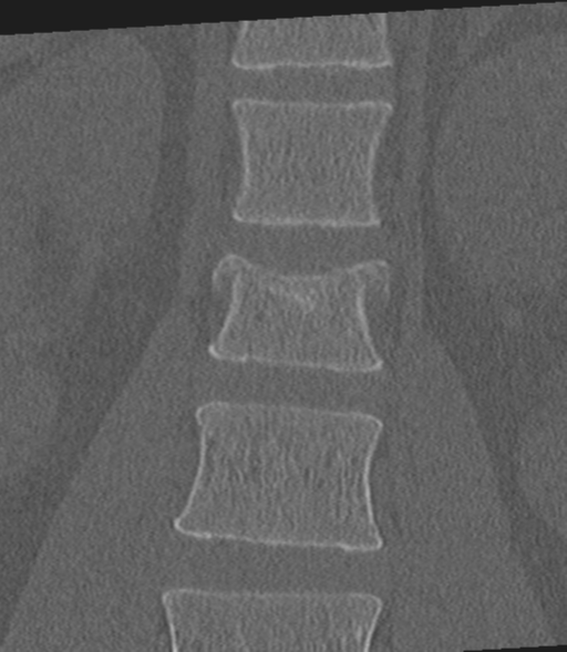 Acute L1 burst compression fracture (Radiopaedia 34430-35755 Coronal bone window 18).png