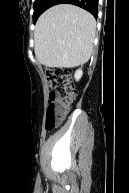 Acute appendicitis (Radiopaedia 22892-22918 Sagittal C+ portal venous phase 17).png
