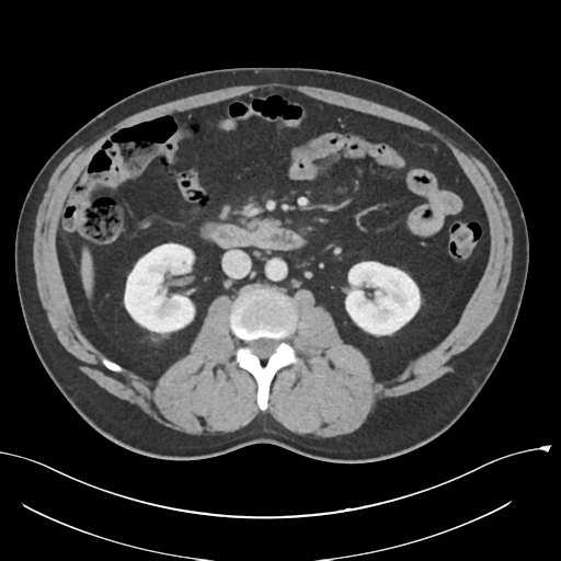 Acute appendicitis (Radiopaedia 36611-38177 Axial C+ portal venous phase 44).png