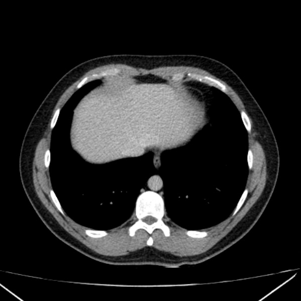 File:Acute appendicitis (Radiopaedia 38255-40270 Axial C+ portal venous phase 7).jpg