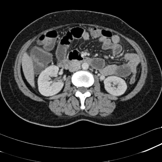 File:Acute appendicitis (Radiopaedia 48792-53822 Axial C+ portal venous phase 52).jpg