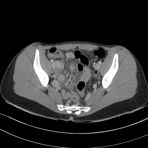 File:Acute appendicitis (Radiopaedia 62608-70901 Axial C+ portal venous phase 33).jpg