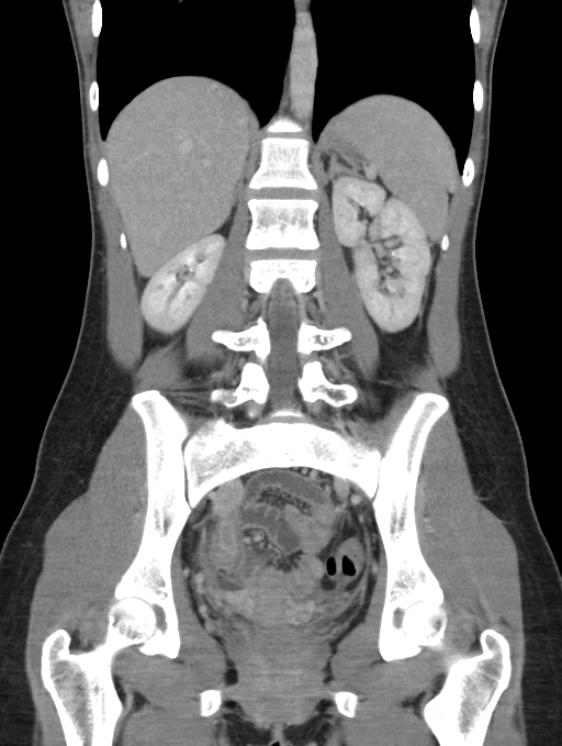 Acute appendicitis (Radiopaedia 62608-70901 Coronal C+ portal venous phase 35).jpg