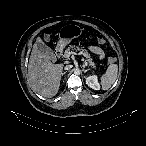 File:Acute appendicitis (Radiopaedia 79950-93224 Axial C+ portal venous phase 34).jpg