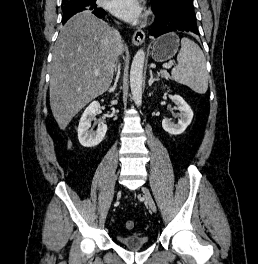 Acute appendicitis (Radiopaedia 79950-93224 Coronal C+ portal venous phase 55).jpg