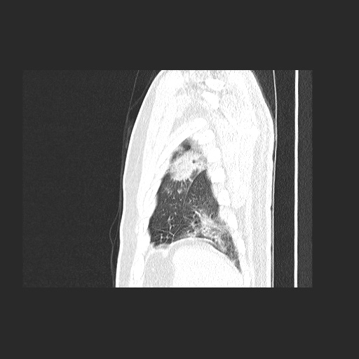 File:Acute appendicitis and COVID 19 pneumonia (Radiopaedia 76604-88380 Sagittal lung window 84).jpg