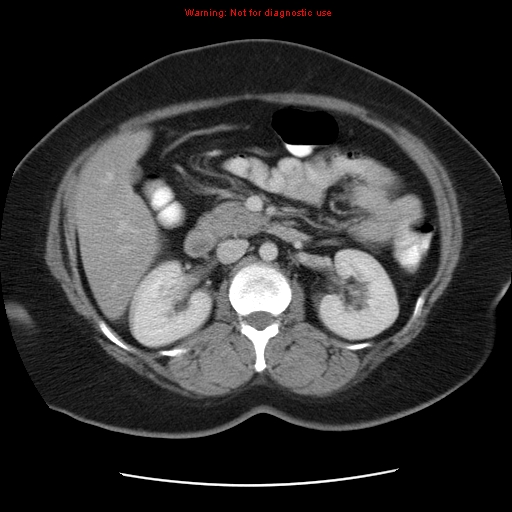 Acute appendicitis complicated by ovarian vein thrombophlebitis (Radiopaedia 16172-15851 Axial C+ portal venous phase 39).jpg
