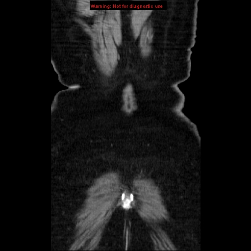 Acute appendicitis complicated by ovarian vein thrombophlebitis (Radiopaedia 16172-15851 Coronal C+ portal venous phase 81).jpg
