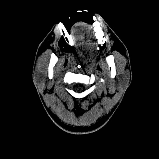Acute basilar artery occlusion (Radiopaedia 43582-46985 Axial non-contrast 8).jpg