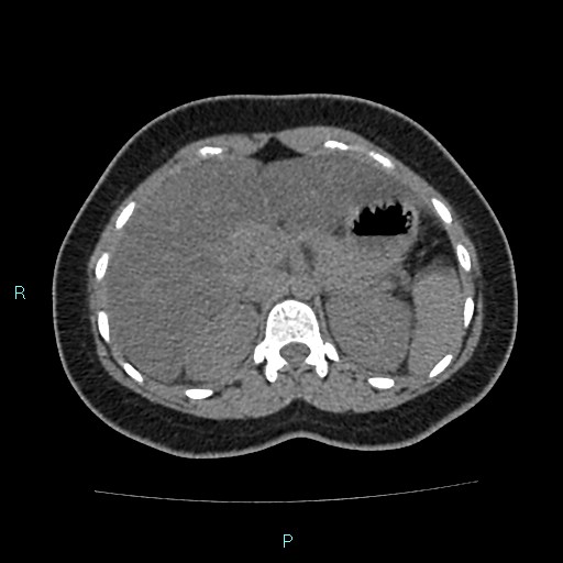 Acute bilateral pyelonephritis (Radiopaedia 37146-38881 Axial non-contrast 31).jpg