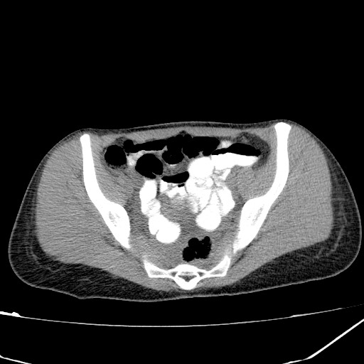 Acute bilateral pyelonephritis (Radiopaedia 74153-84969 Axial non-contrast 41).jpg