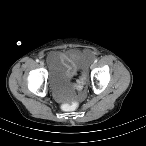 Acute bowel ischemia (Radiopaedia 87695-104114 Axial C+ portal venous phase 77).jpg