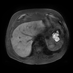 File:Acute cholecystitis complicated by pylephlebitis (Radiopaedia 65782-74915 Axial T1 fat sat 15).jpg