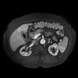 File:Acute cholecystitis complicated by pylephlebitis (Radiopaedia 65782-74915 Axial arterioportal phase T1 C+ fat sat 68).jpg