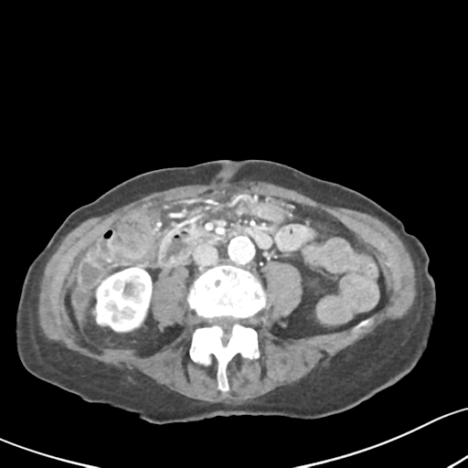 Acute cholecystitis with contained perforation (Radiopaedia 47328-51907 Axial C+ portal venous phase 39).png