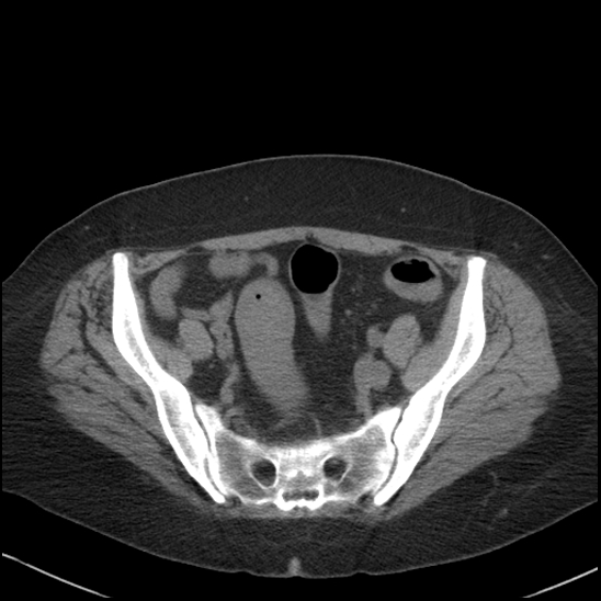 Acute colonic hemorrhage in ulcerative colitis (Radiopaedia 77415-89538 Axial non-contrast 107).jpg