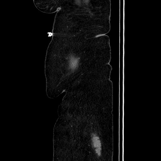 Acute diverticulitis - transverse colon (Radiopaedia 87063-103327 Sagittal C+ portal venous phase 38).jpg