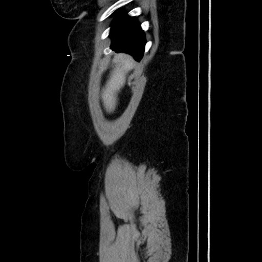 Acute diverticulitis - transverse colon (Radiopaedia 87063-103327 Sagittal C+ portal venous phase 50).jpg