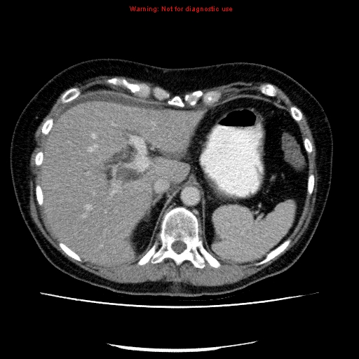 File:Acute gangrenous cholecystitis (Radiopaedia 10123-10661 Axial C+ portal venous phase 22).jpg